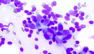 A microscopic view of cancer cells